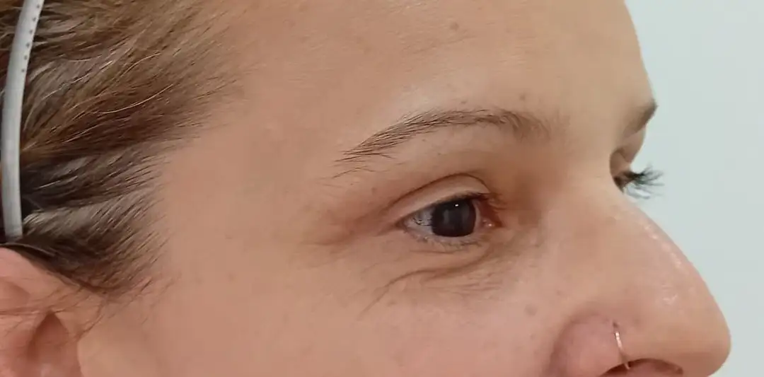 Blefaroplastia_01_Antes