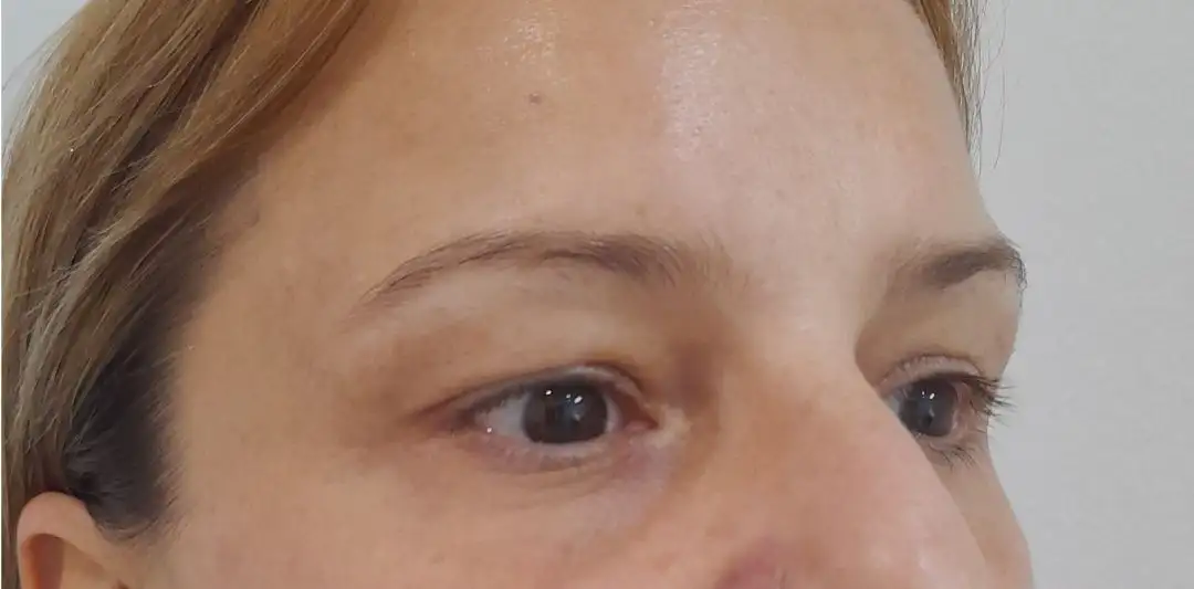 Blefaroplastia_01_Depois
