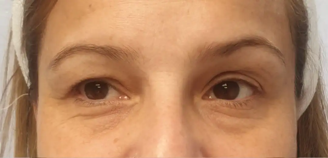 Blefaroplastia_02_Antes