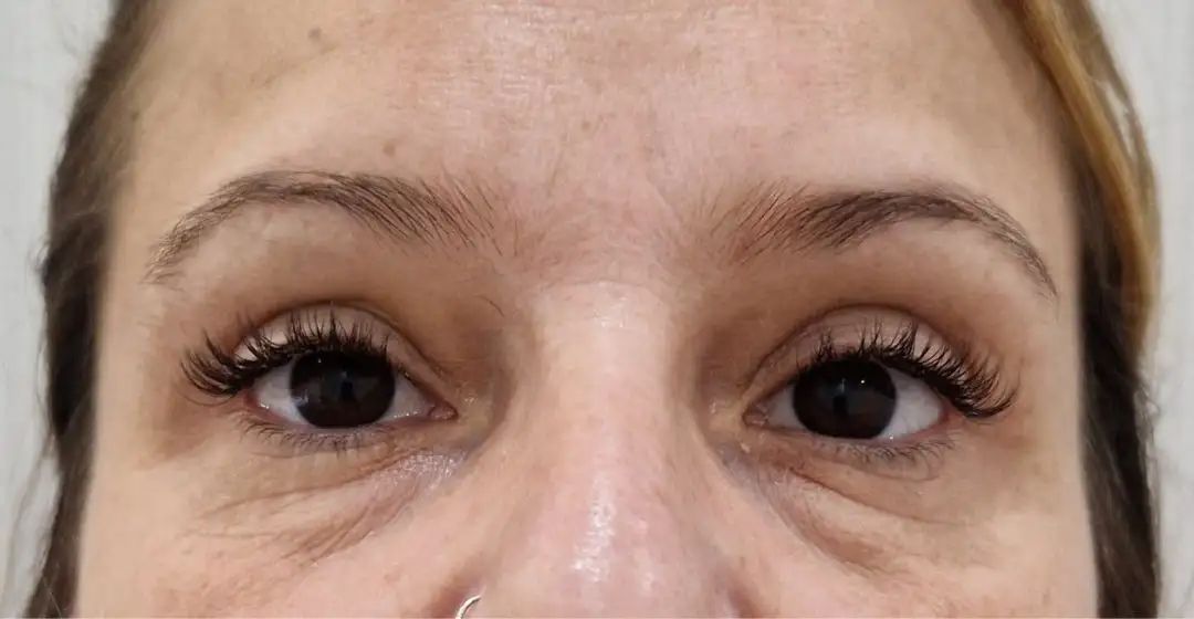 Blefaroplastia_02_Depois