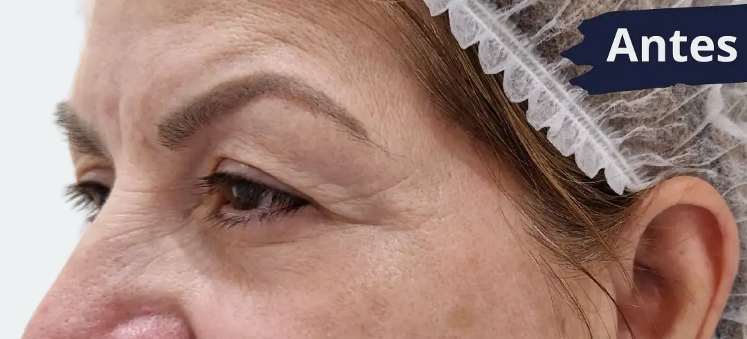 Blefaroplastia_03_Antes
