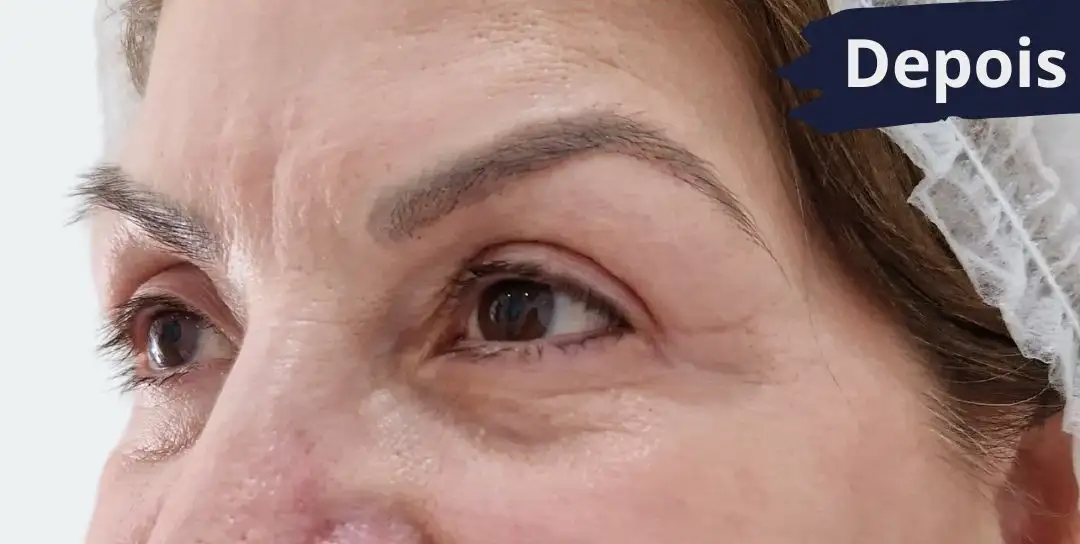 Blefaroplastia_03_Depois