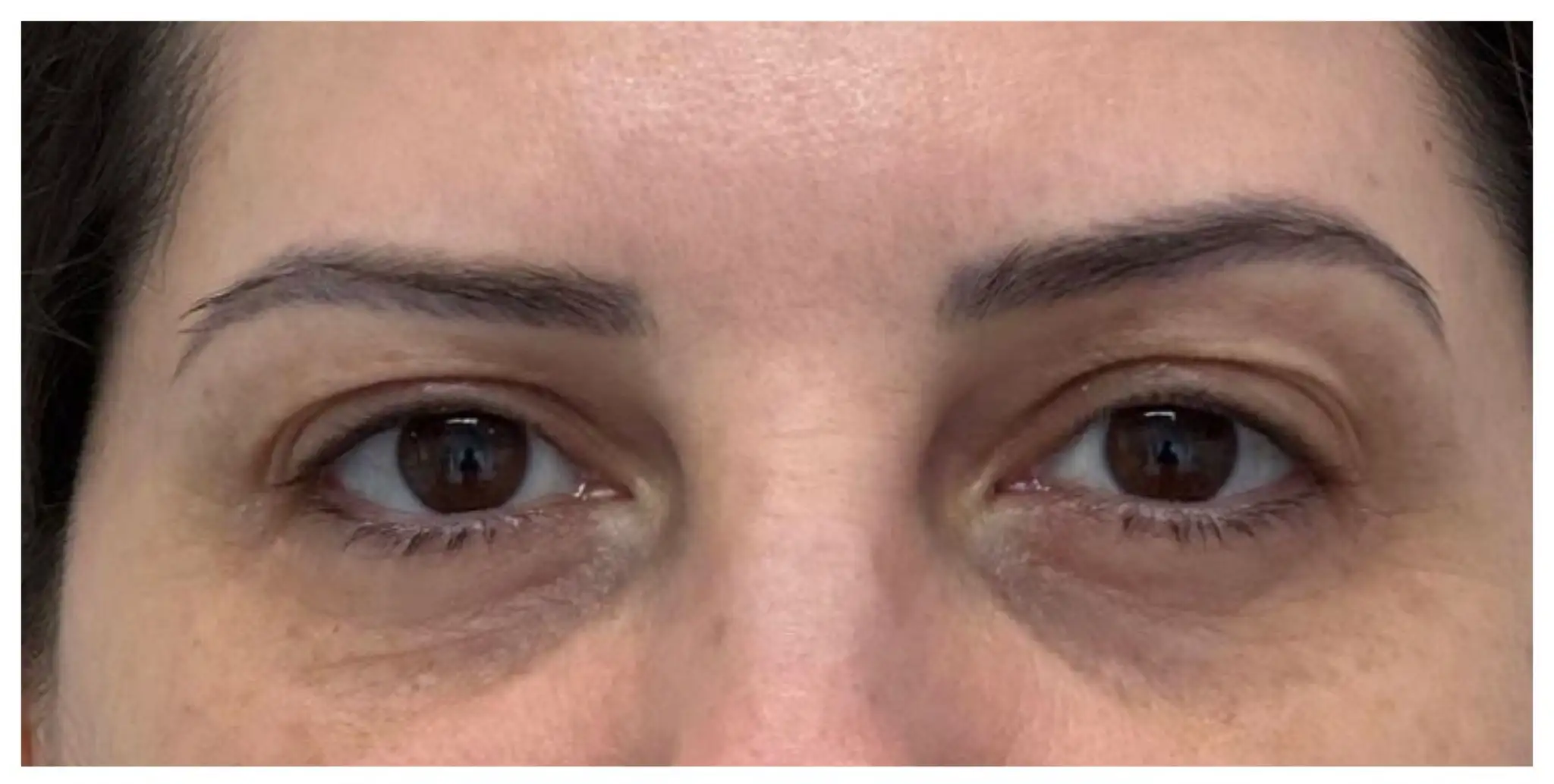 Blefaroplastia_04_Antes