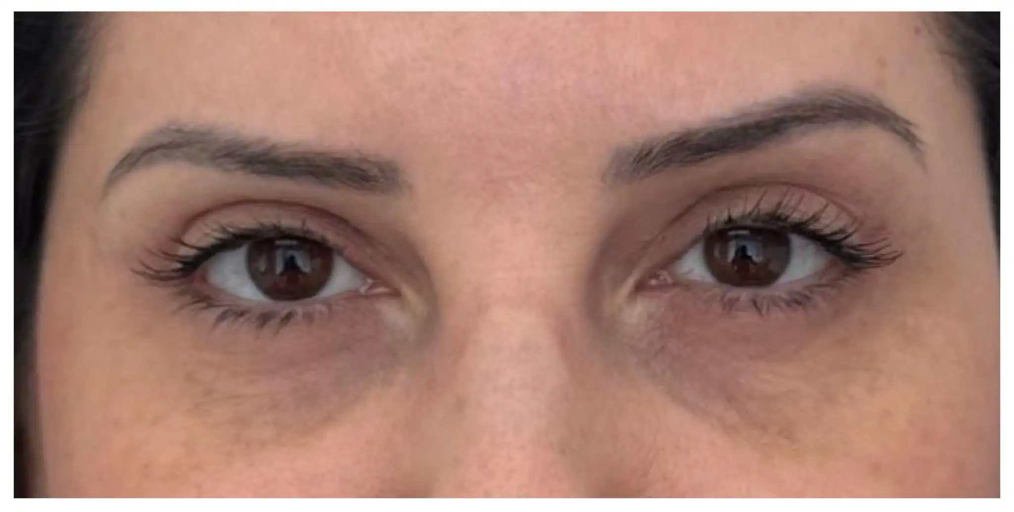 Blefaroplastia_04_Depois