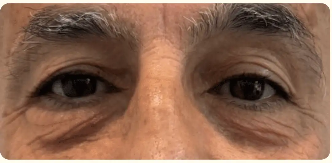 Blefaroplastia_06_Antes