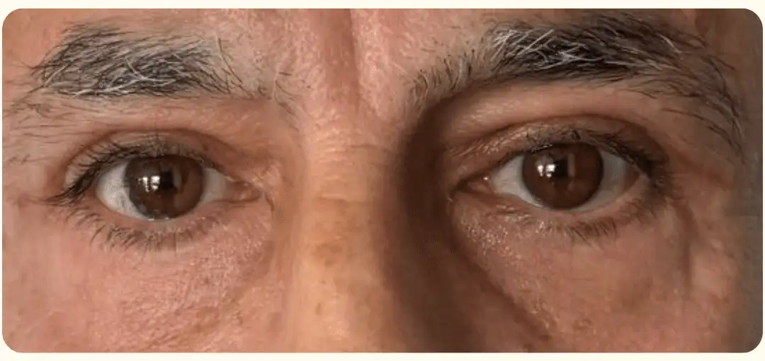 Blefaroplastia_06_Depois