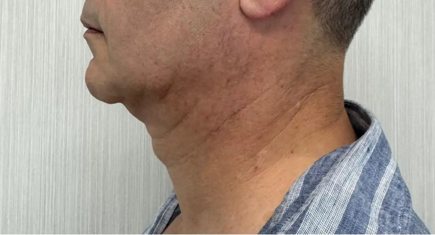 CirurgiaDePapada_01_Antes