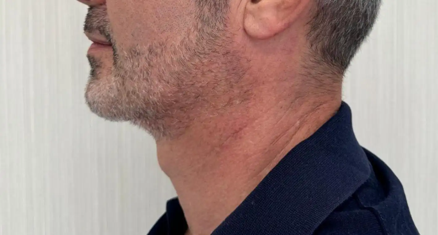 CirurgiaDePapada_01_Depois