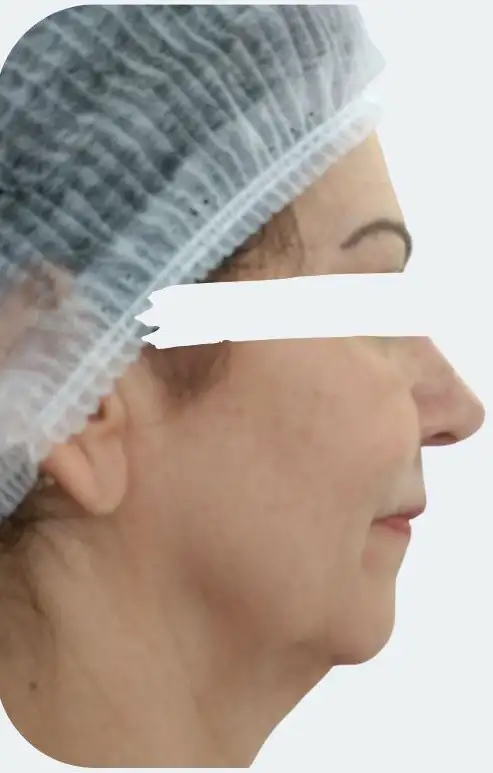 FiosTensores_01_Antes