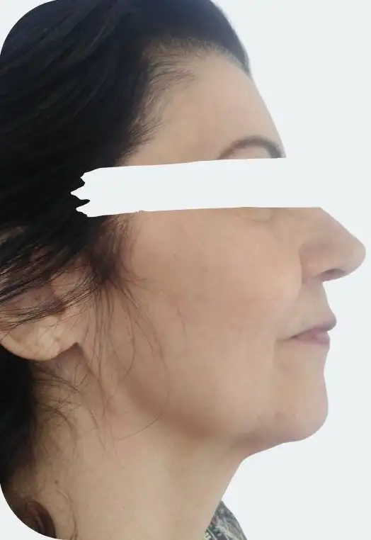 FiosTensores_01_Depois