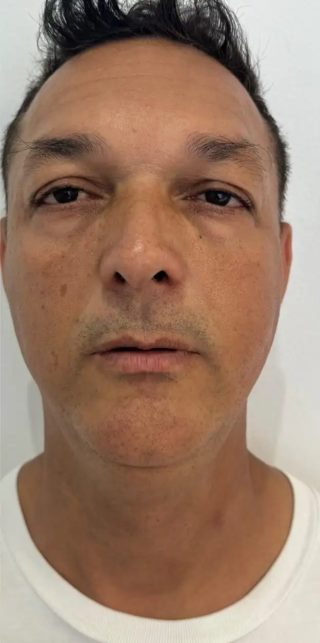 FiosTensores_02_Depois