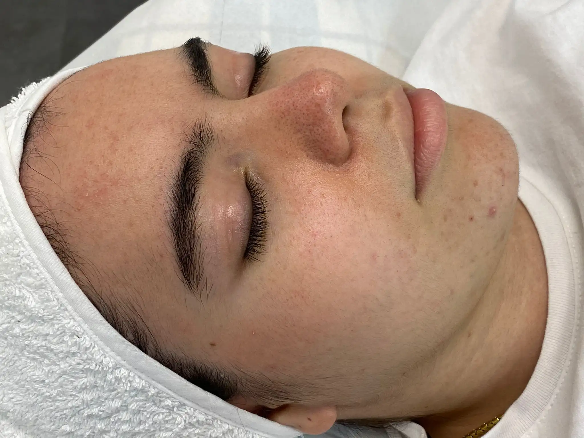 LimpezaDePele_01_Antes