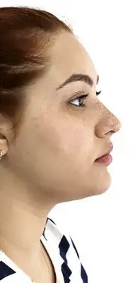 LipoDePapada_01_Depois