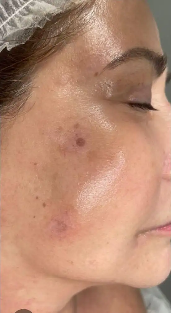 Peeling_01_Antes (1)