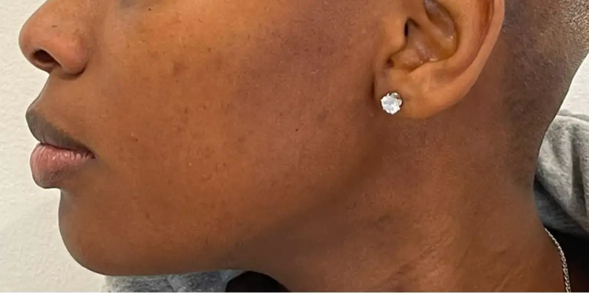 Preenchimento_01_Antes