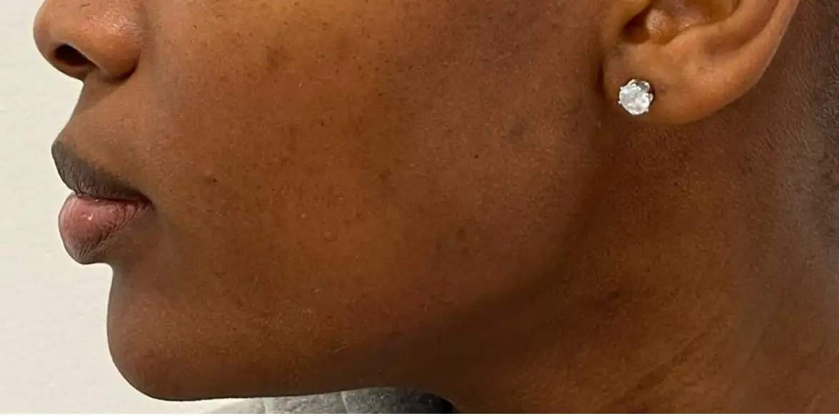 Preenchimento_01_Depois