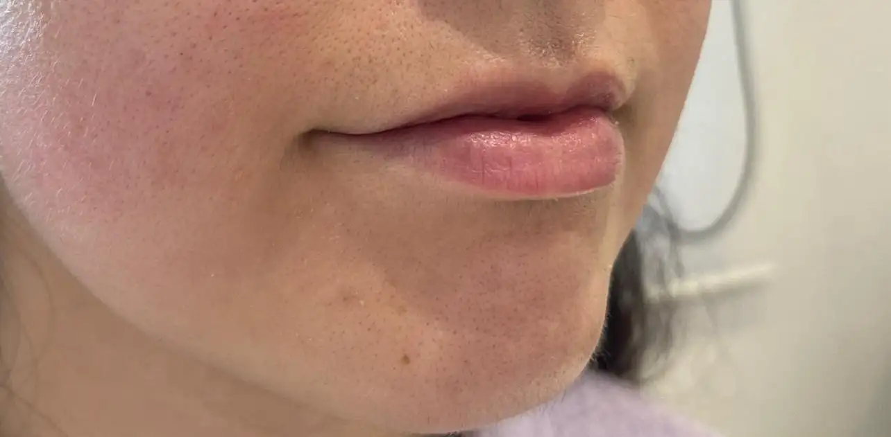 Preenchimento_02_Antes