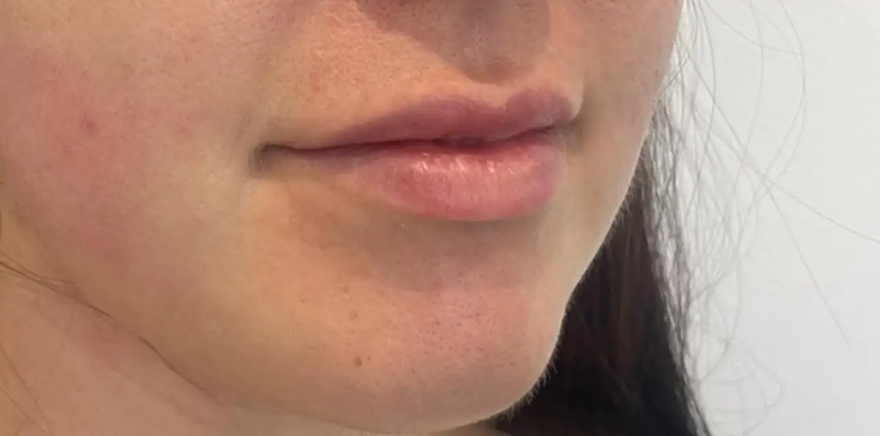 Preenchimento_02_Depois