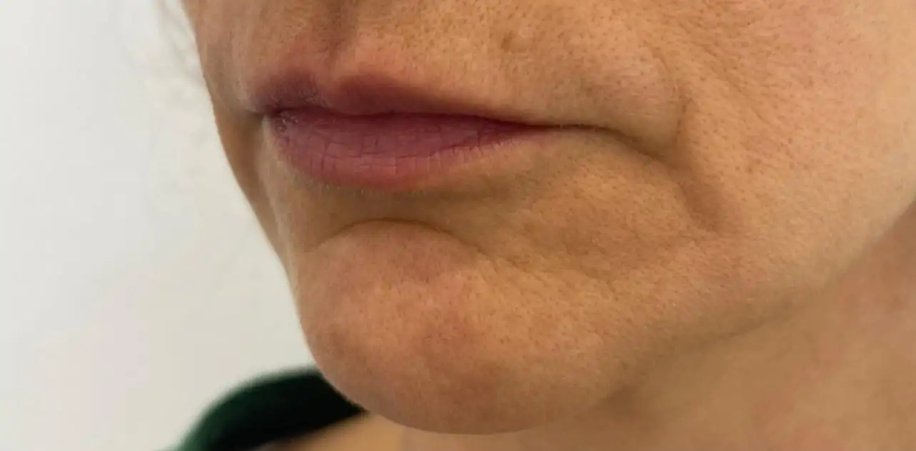 Preenchimento_03_Antes