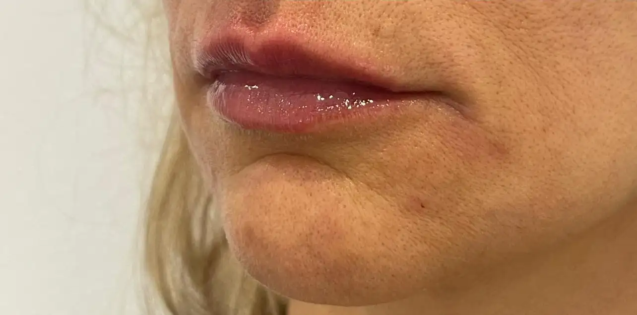 Preenchimento_03_Depois