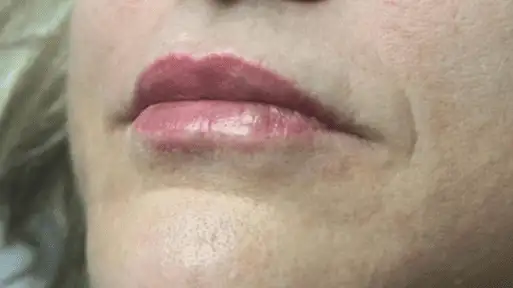 Preenchimento_04_Depois