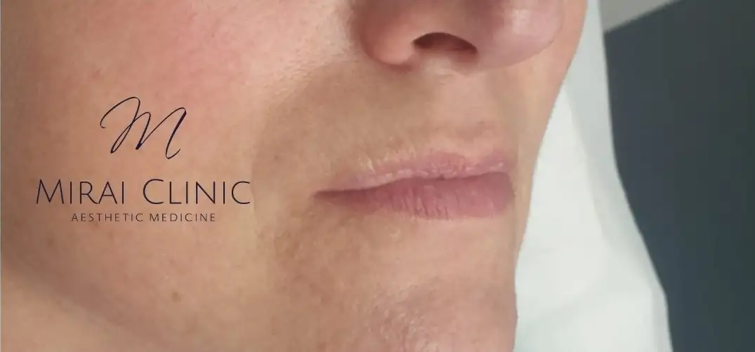 Preenchimento_05_Antes