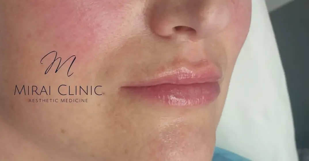 Preenchimento_05_Depois