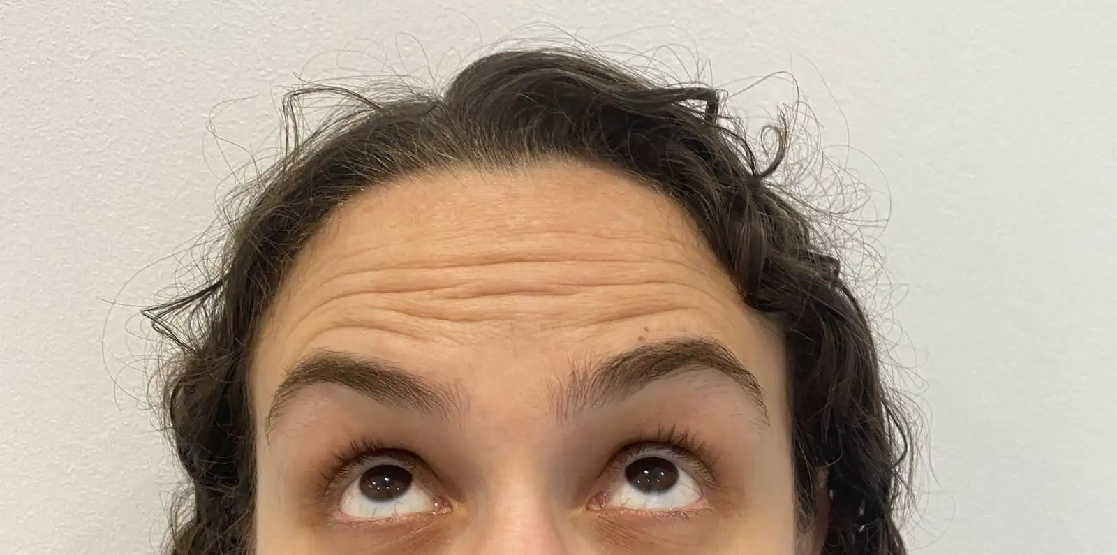 ToxinaBotulinica_01_Antes