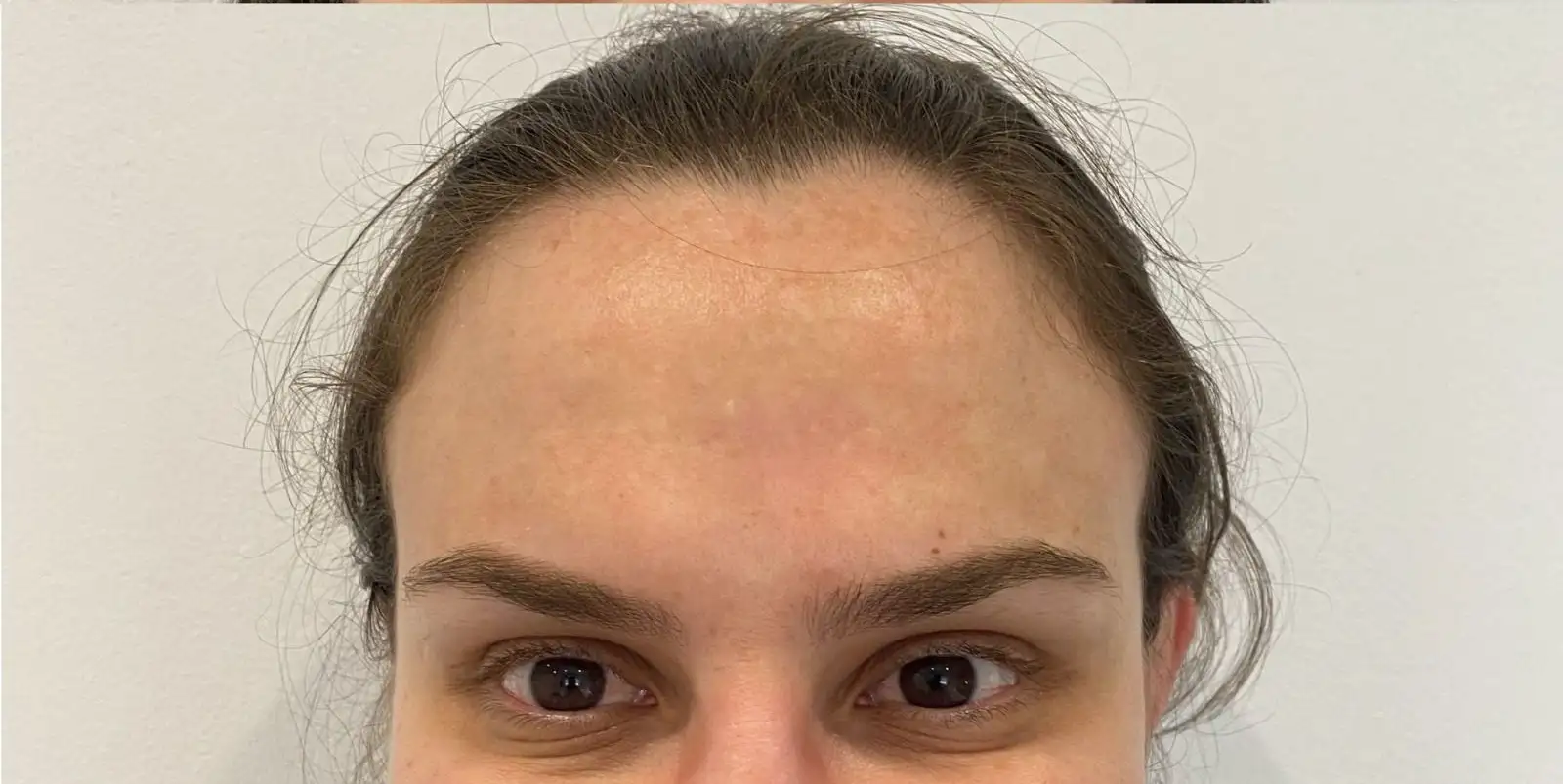 ToxinaBotulinica_01_Depois