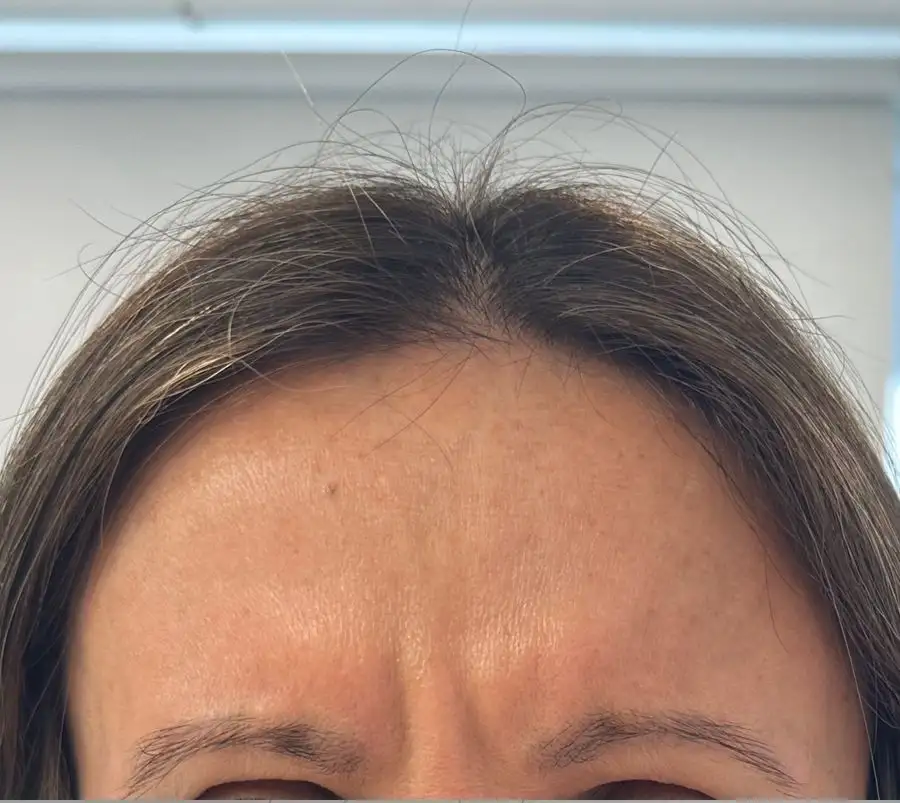 ToxinaBotulinica_02_Antes