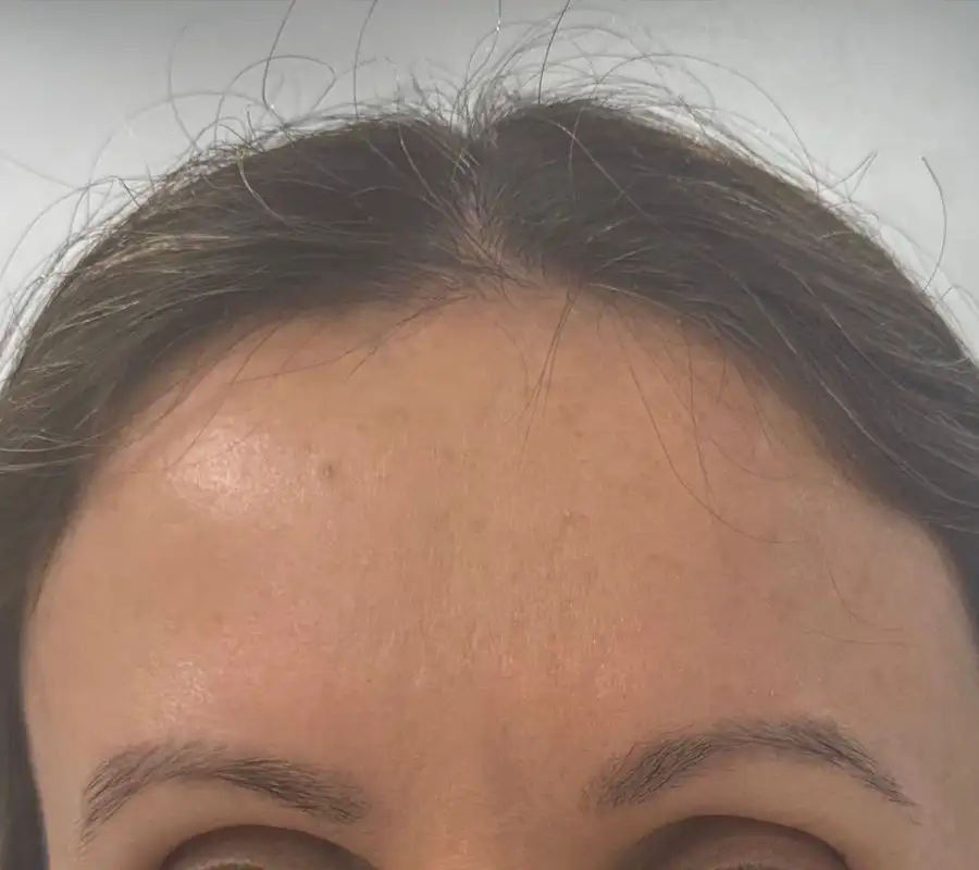 ToxinaBotulinica_02_Depois