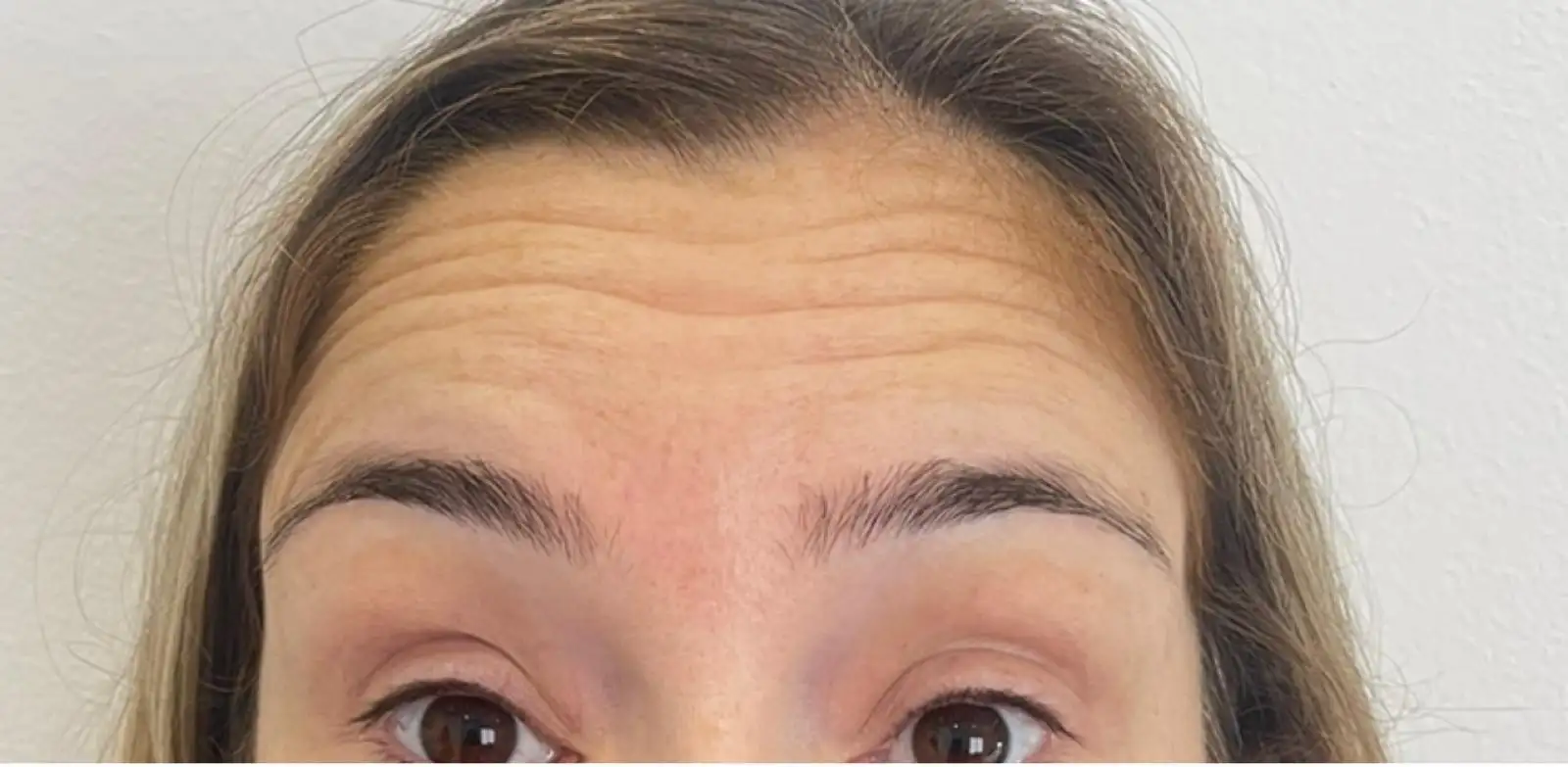 ToxinaBotulinica_03_Antes