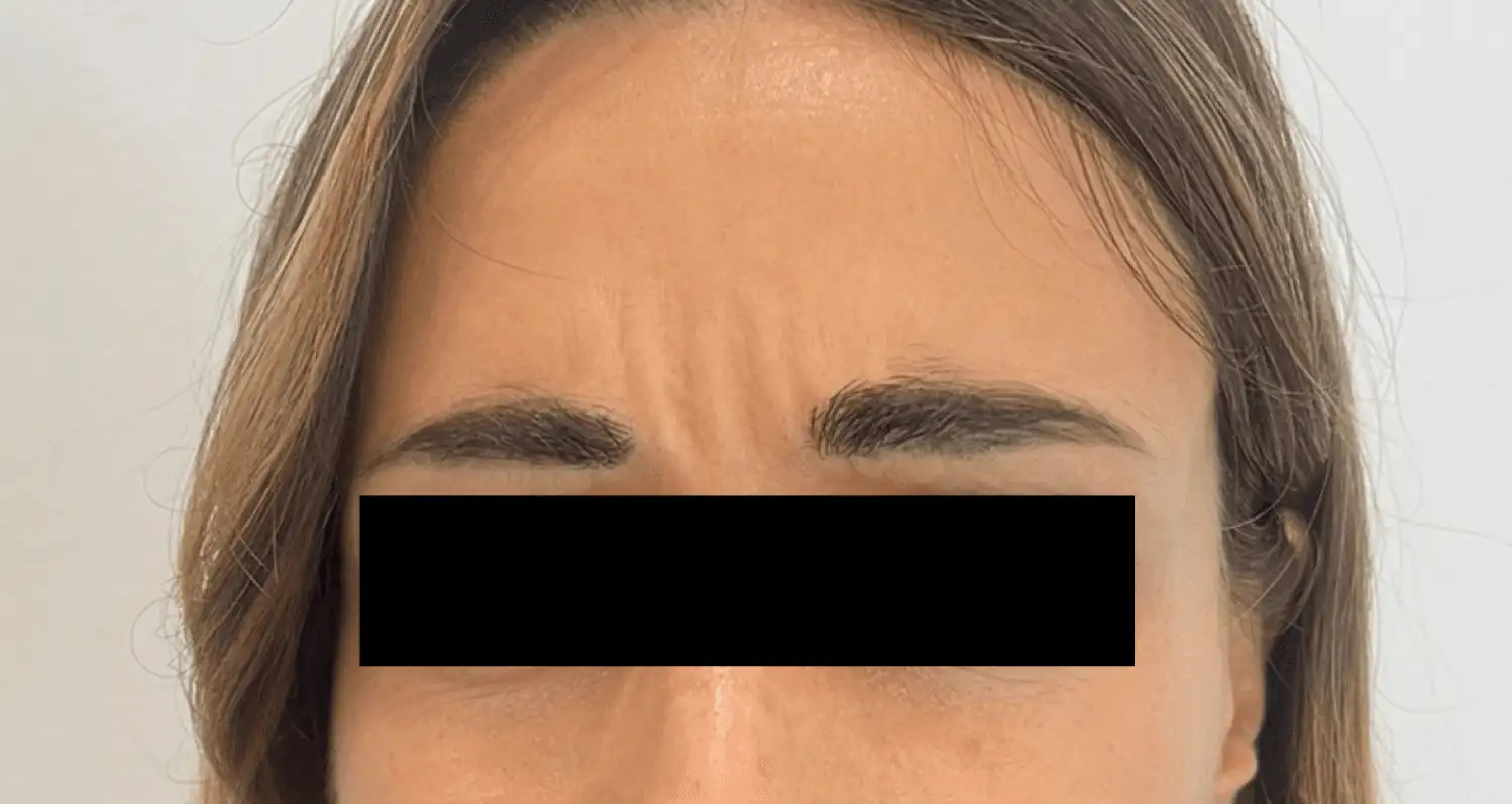 ToxinaBotulinica_04_Antes