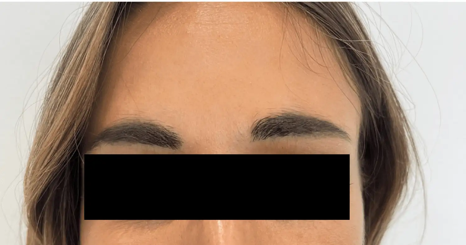 ToxinaBotulinica_04_Depois