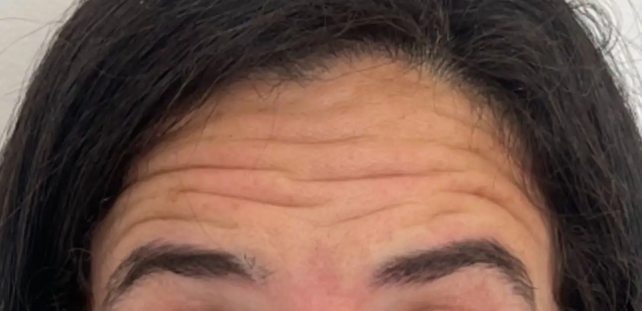 ToxinaBotulinica_05_Antes