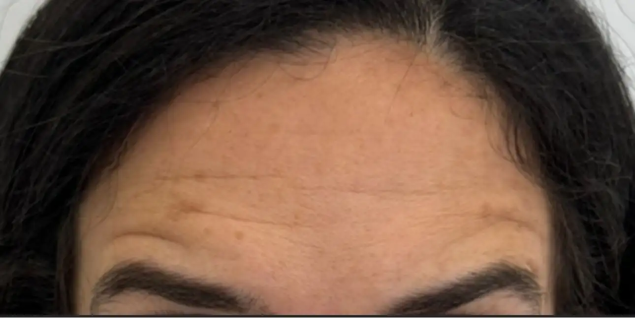 ToxinaBotulinica_05_Depois