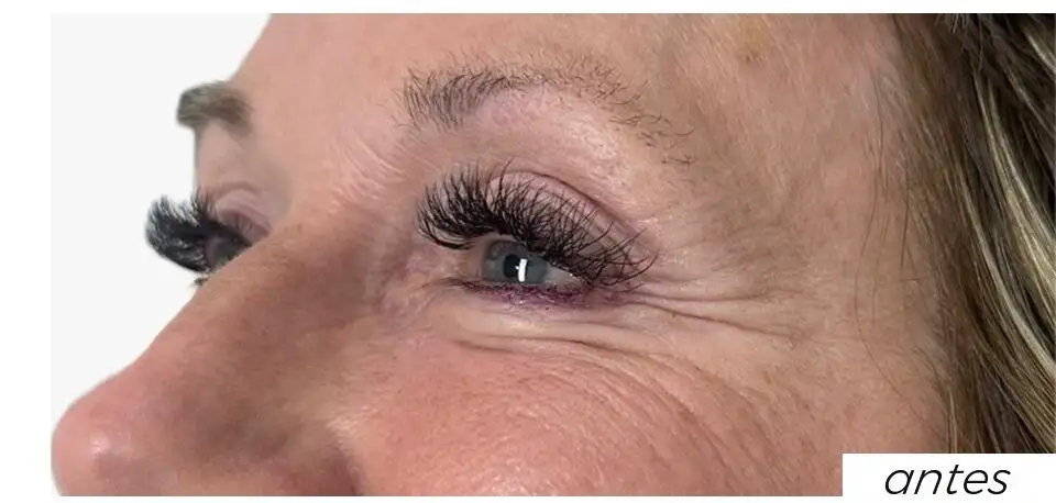 ToxinaBotulinica_06_Antes