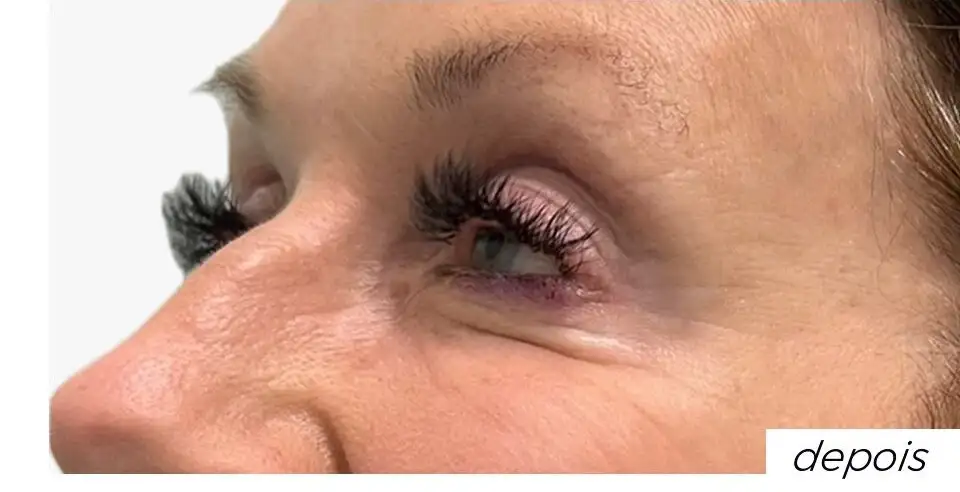 ToxinaBotulinica_06_Depois