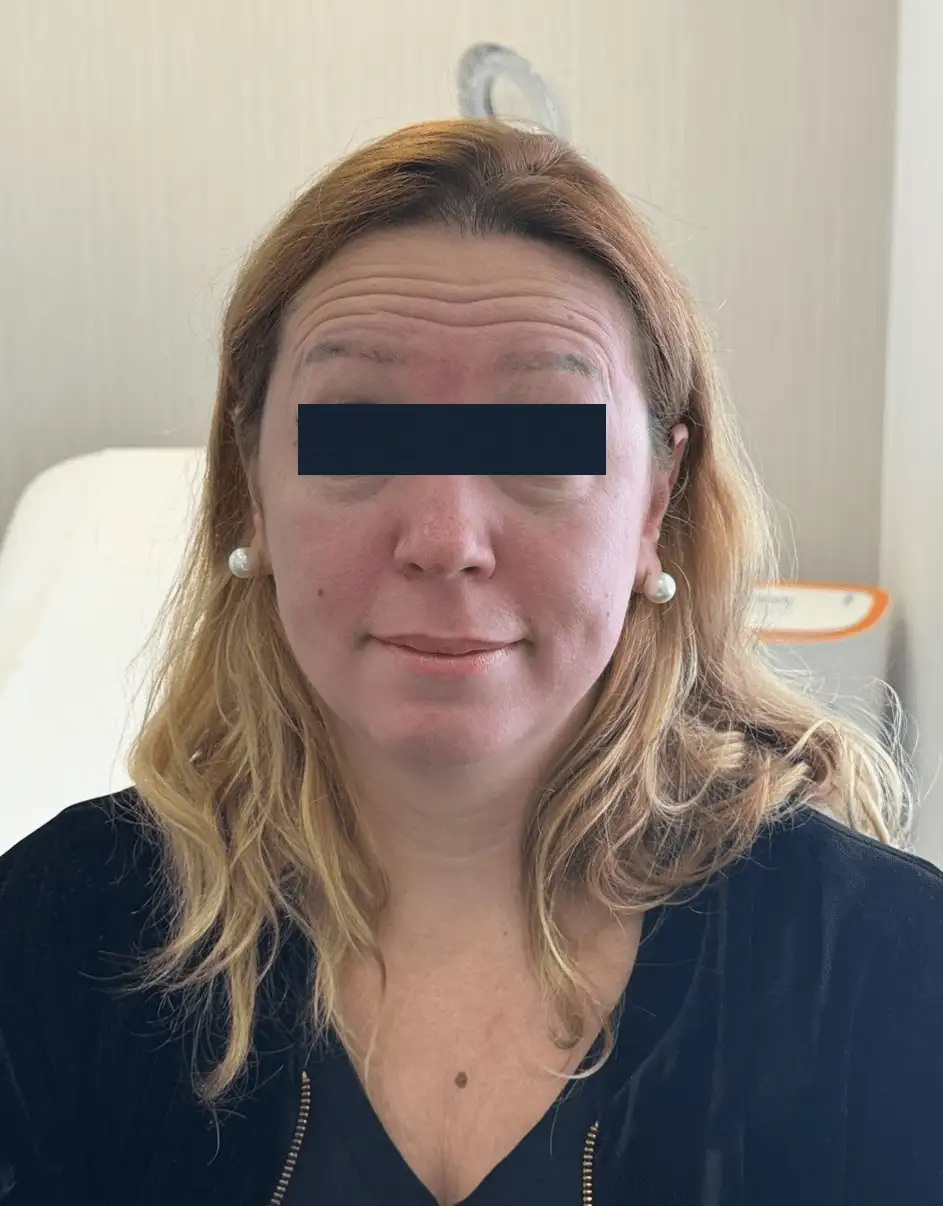 ToxinaBotulinica_07_Antes