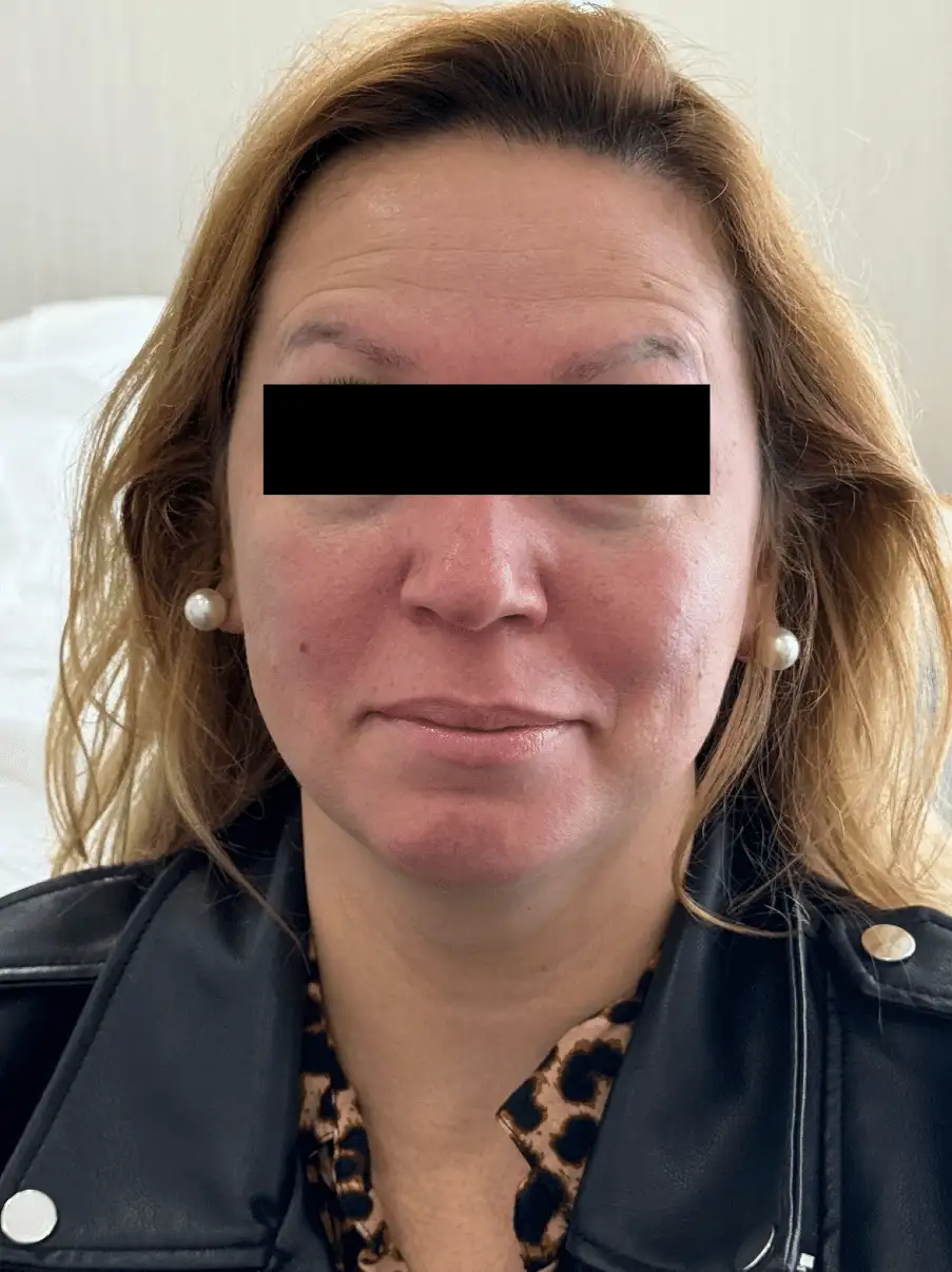 ToxinaBotulinica_07_Depois